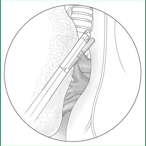 Indications For Lobectomy Download Scientific Diagram