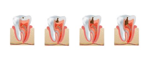 Las 4 fases de las caries dentales Clínica Dental Elena Toledano