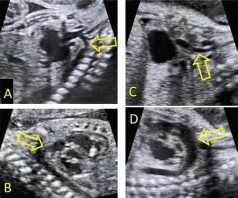 Congenital Abnormalities Of The Fetal Heart Intechopen