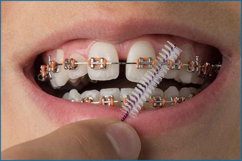 Tips To Care Teeth Braces Advice From Our Orthodontist Oris Dental Center