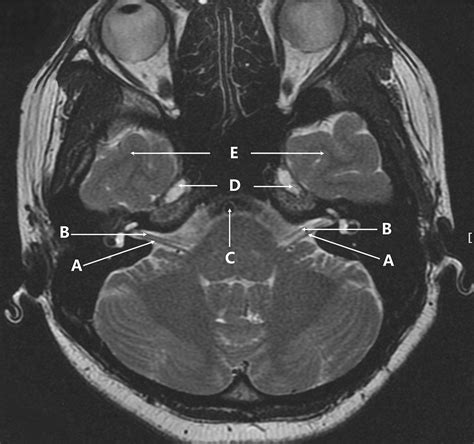 Axial T2 Weighted Magnetic Resonance Image Of The Base Of The Brain