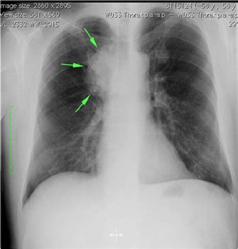 The Mass Image In The Right Lung Chest X Ray Figure 2 The Mass Download Scientific Diagram