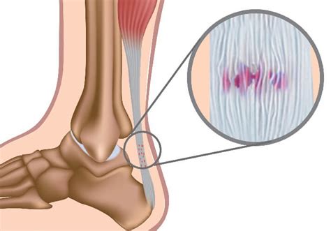 Tendon On The Back Of The Foot Hotsell Emergencydentistry