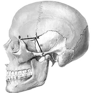 Measurements taken on each skull. I, distance from the pterion (A) to ...