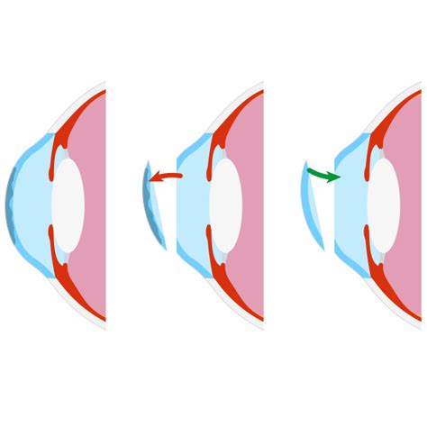 Cornea Transplant Dallas, TX - Fort Worth - Plano - Keratoplasty - Cornea Associates of Texas