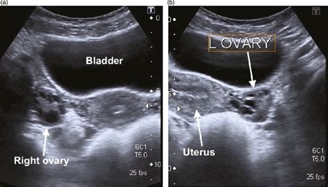 Normal Pelvic Ultrasound