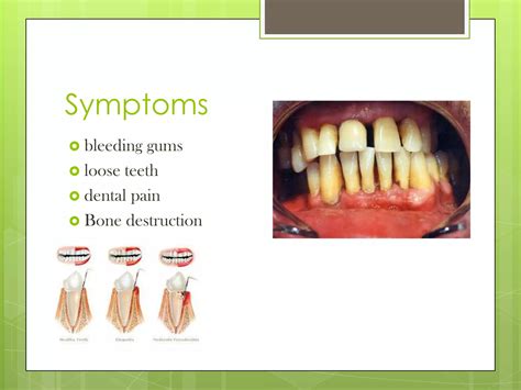 Periodontal Disease PPT