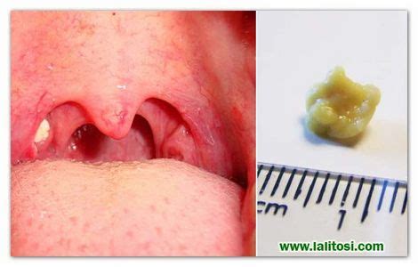 TONSILLOLITI (calcoli tonsillari): CAUSE, CURE, RIMEDI