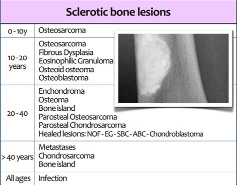 Sclerotic Bone Leison Note Sclerotic Bone Leison In Tibia In Young