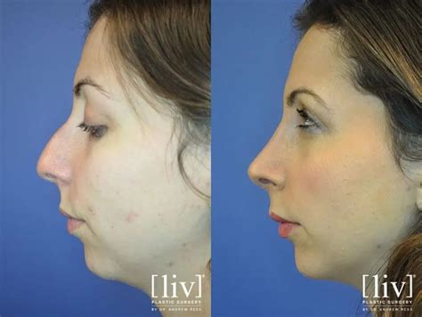 Rhinoplasty Recovery Timeline And Tips You Need To Know Liv Plastic