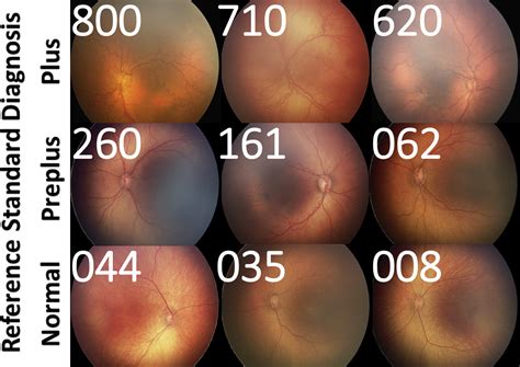 Plus Disease In Retinopathy Of Prematurity Ophthalmology