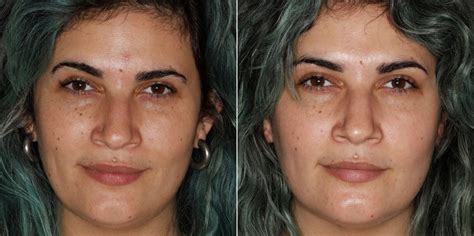 Laser Resurfacing Before And After Photos Dermatology Circle Dr