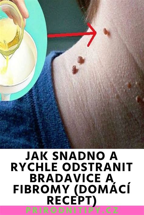 Jak Snadno A Rychle Odstranit Bradavice A Fibromy Dom C Recept In