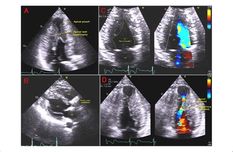 Transthoracic Echocardiography 2 Chamber Systolic Frame A Showing