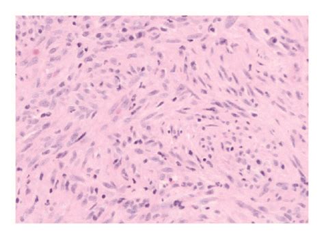 Spindle Cell Proliferation With Intersecting Fascicles Haematoxylin