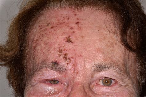 Shingles Rash Affecting Facial Nerve Bild Kaufen 12919409 Science