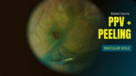 Pars Plana Vitrectomy Peeling To Treat A Macular Hole Youtube