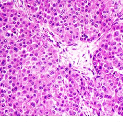 Figure From Hepatoid Variant Of Yolk Sac Tumor Of Both Ovaries With