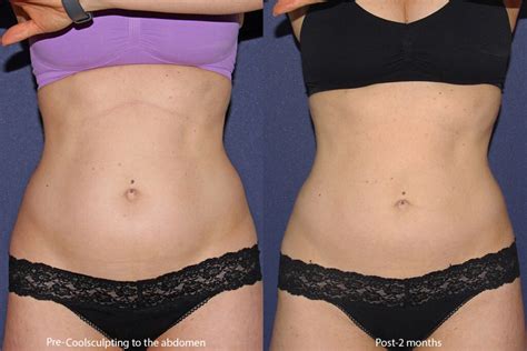 Non Invasive Body Shaping Vs Traditional Liposuction Which Is Right For You Cosmetic Laser