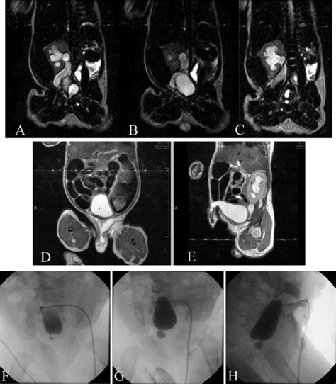 First Case Of A Term Male Born With Aphallia And Complete Urethral