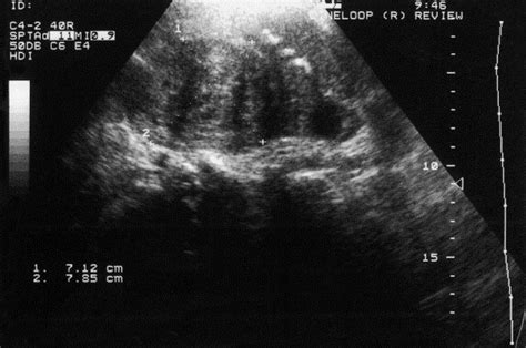 Tubo Ovarian Abscesses In Postmenopausal Women Gynecological