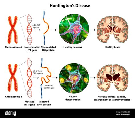 Molecular Genesis Of Huntington S Disease 3D Illustration Stock Photo