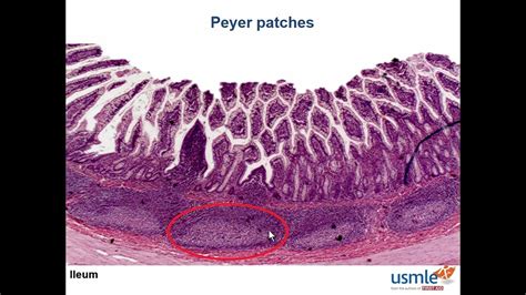 USMLE-Rx Express Video of the Week: Peyer Patches - YouTube