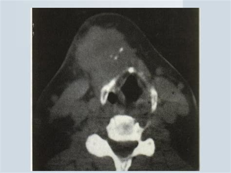 Patologia Quirurgica De Tiroides Y Paratiroides Ppt