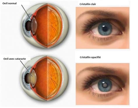 Op Ration Et Chirurgie De La Cataracte Prendre Rdv