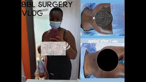 BBL LIPO 360 JOURNEY SURGERY DAY 2020 Experience Results Pain