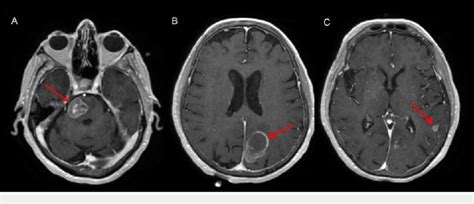 Representative MRI images at diagnosis, showing three brain lesions... | Download Scientific Diagram