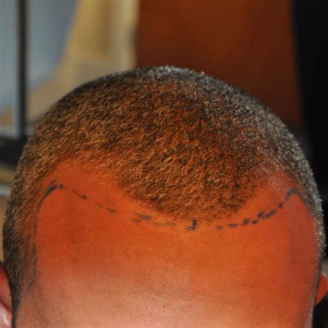 1000 Graft Hair Transplant Coverage Costs Results