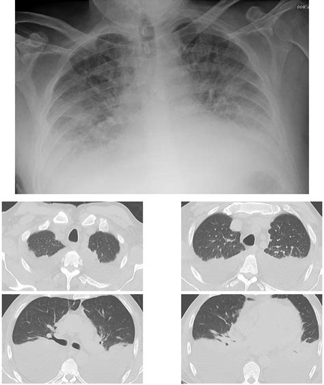 Simple Quantitative Chest Ct For Pulmonary Edema European Journal Of