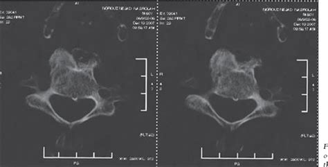 Figure 2 From Respiratory Distress And Dysphagia Secondary To Diffuse Idiopathic Skeletal