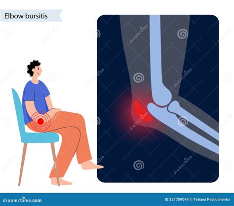 Bursitis Del Codo Estudiantil Ilustración del Vector Ilustración de