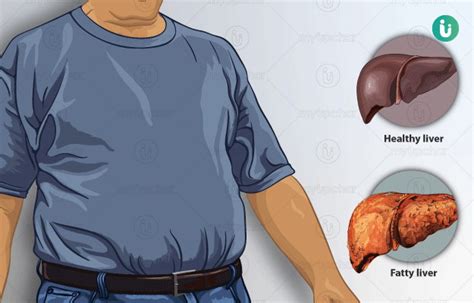 Fatty Liver Symptoms Causes Prevention Diagnosis