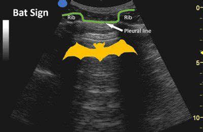 POCUS Lung Introduction To A Lines And B Lines Point Of Care