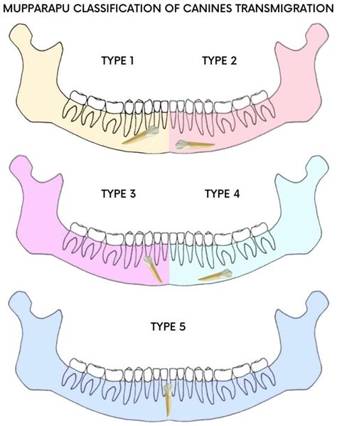 Orthodontic Surgical Treatment Of Impacted Mandibular Canines