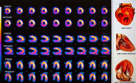 Cintilografia Do Mioc Rdio Hospital Cardiol Gico Costantini