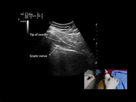 Piriformis Syndrome Injection