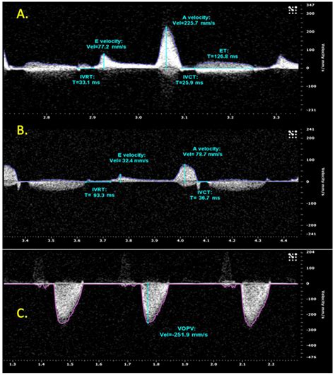 Pulse Wave Doppler Image Of Ventricular Inflow And Outflow Download Scientific Diagram