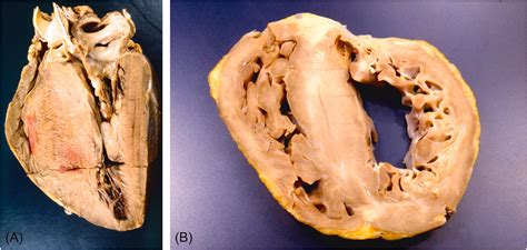 Cardiomyopathies Clinical Tree