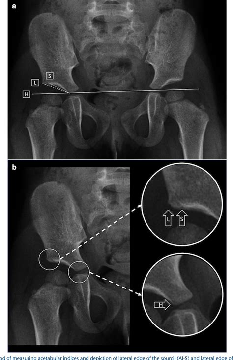 Figure 1 From The Lateral Edge And Sourcil Acetabular Indices For