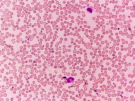 Iron Deficiency Anemia Under Microscope