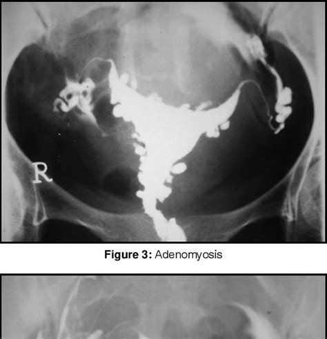 Pattern Of Pathologies On Hysterosalpingography In Primary Infertility