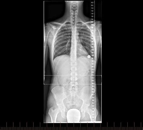 Digital X Ray Patient Fact Sheet Melbourne Radiology