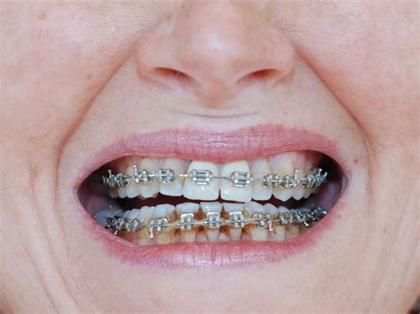 5 Signs Of Tooth Decay With Braces