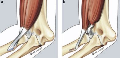 Distal Biceps Rupture Elbow Surgery Oklahoma City Hand Surgery