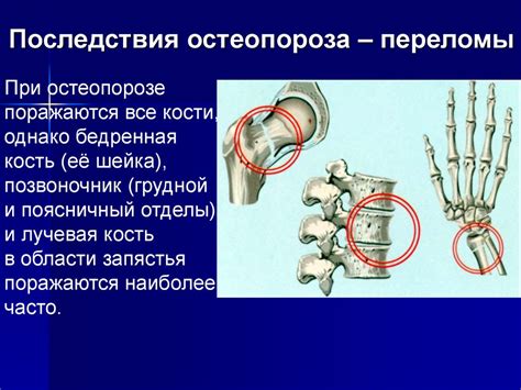 Остеопороз. Изменения в костях при остеопорозе - online presentation