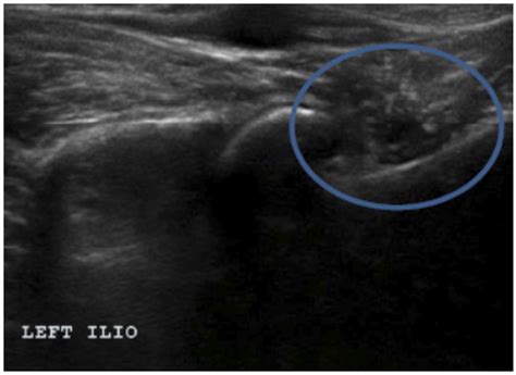 Iliopsoas Bursitis Ultrasound